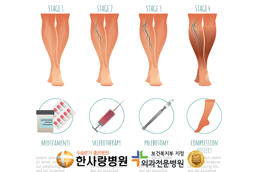 하지정맥류수술 (3).png