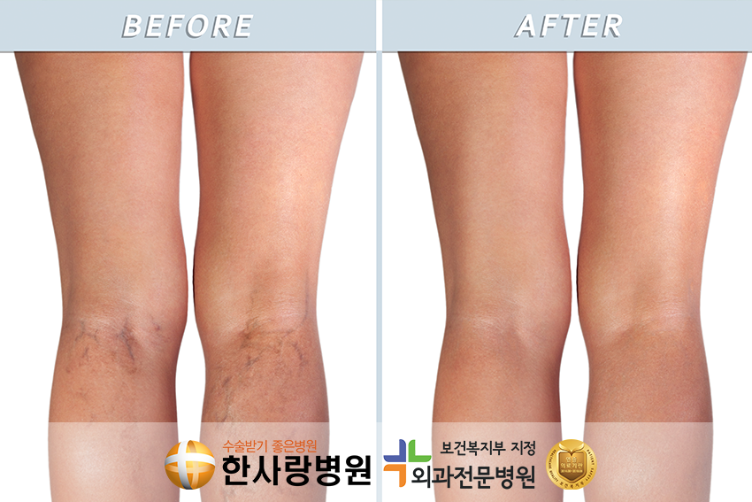 하지정맥류통증 (5).png
