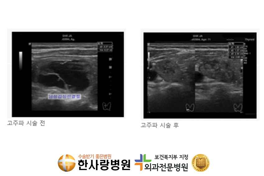 갑상샘기능항진증 (6).png