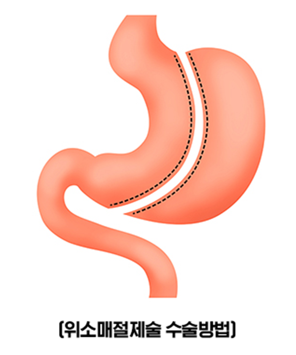 6위소매절제술(작업).png