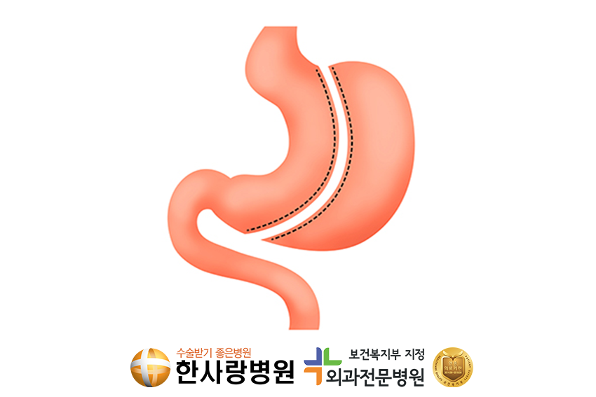 고도비반수술 (5).png