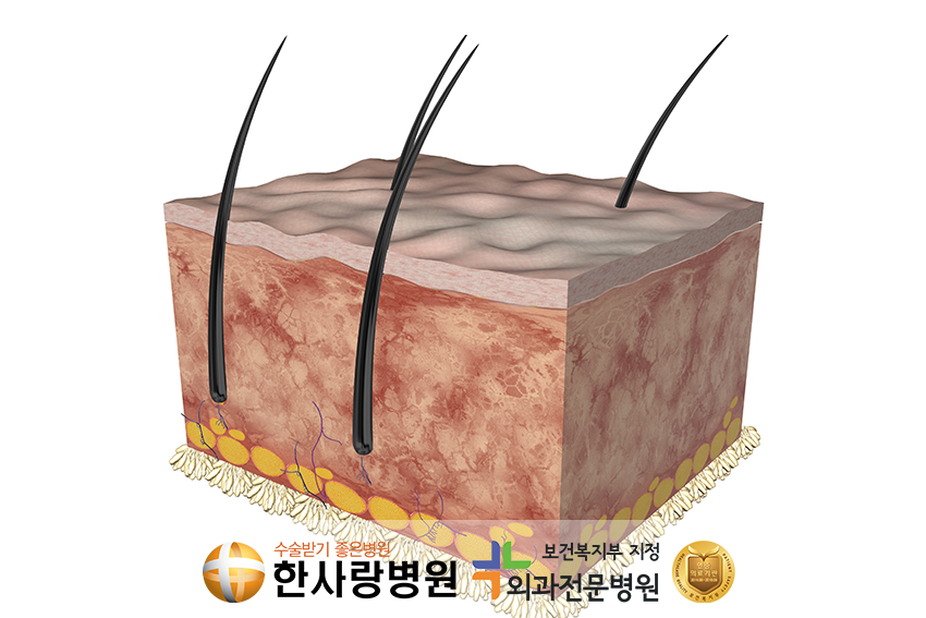 2도 3도 화상 (4).png