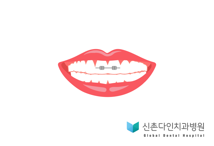 신촌다인치과_부분교정.png