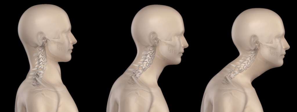 lg_c16123191828803_Forward-Head-Posture-1024x388.png