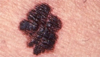 오존층 피해.png