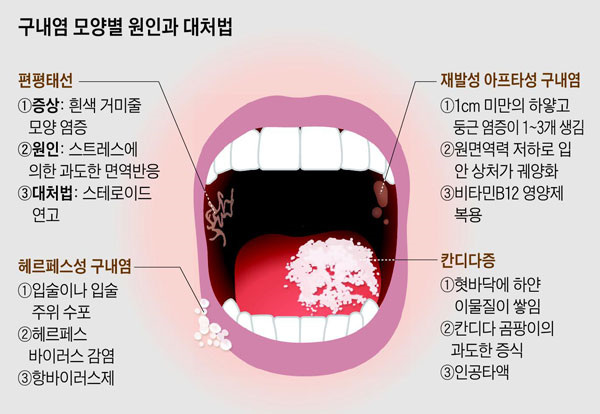 구내염.png