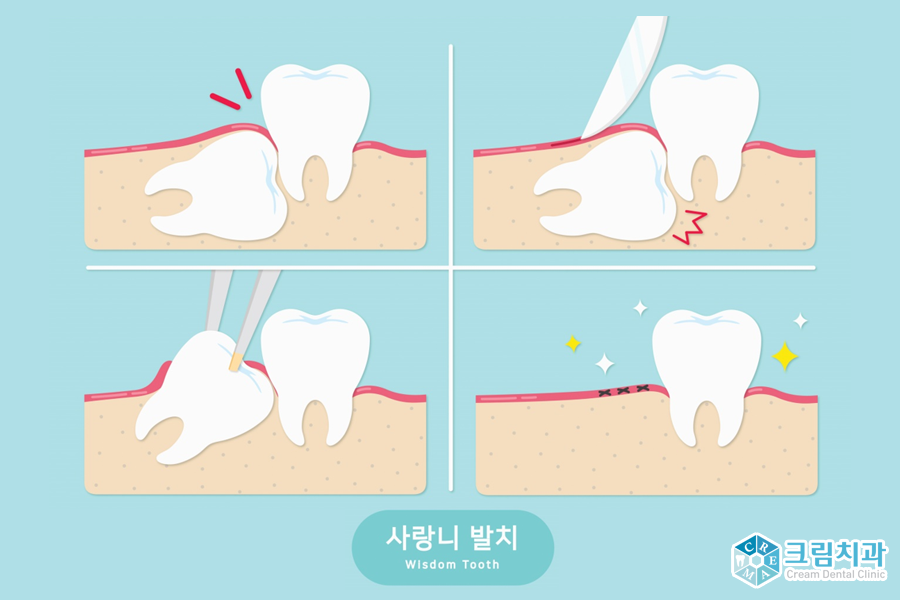 사랑니발치1.png
