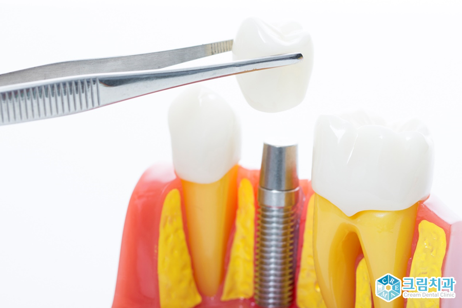건강보험임플란트2.png