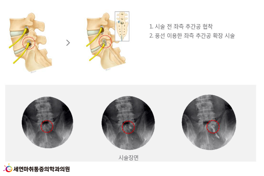 8 풍선확장술.png