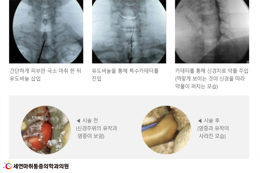 5 신경성형술.png