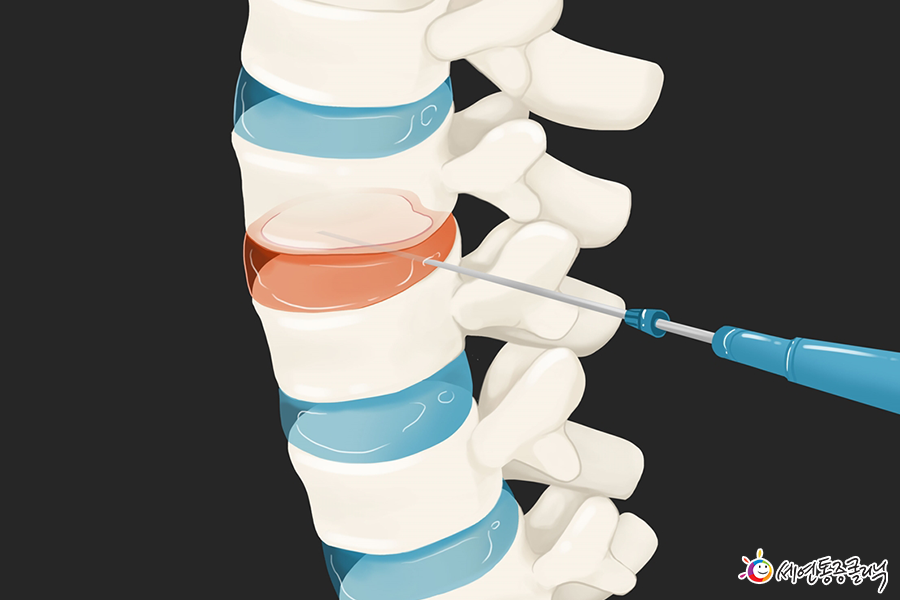 퇴행성디스크3.png