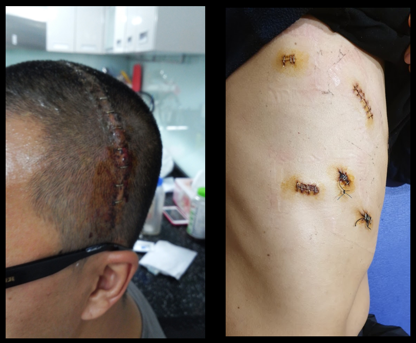 2개의 암 수술자국.png