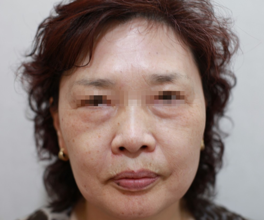 얼굴의 노화.png