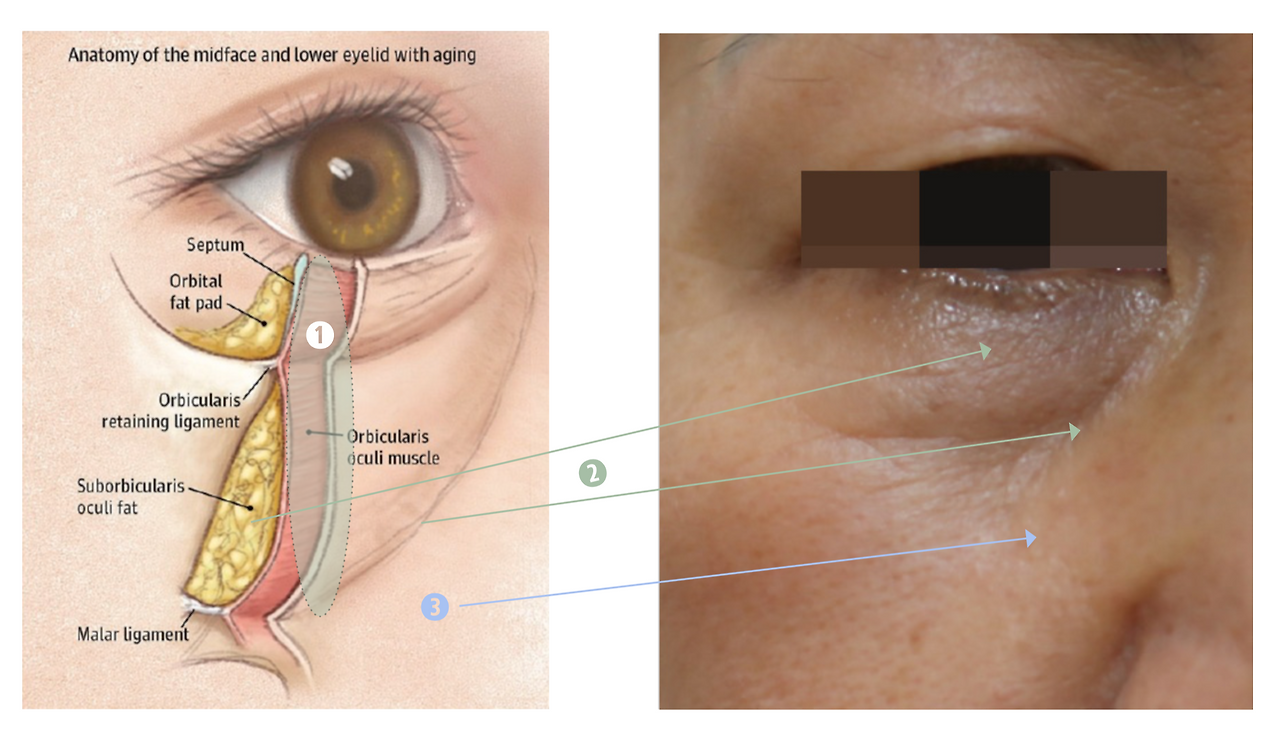 눈밑지방.png