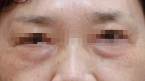 얼굴의 노화.png