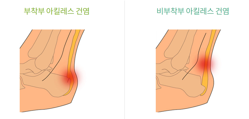 아킬레스건염위치.png