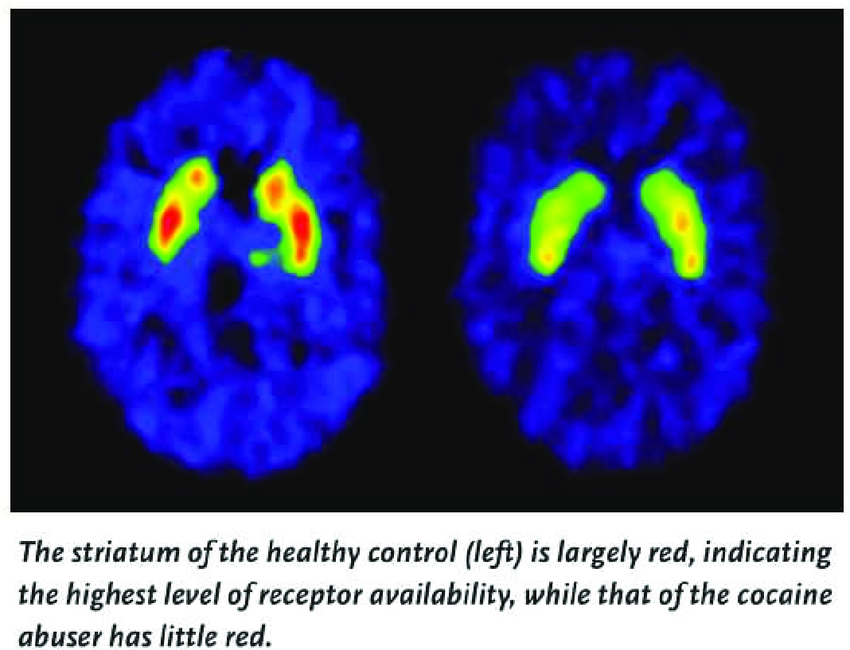 PET-Brain-scan-showing-reduced-dopamine-D2-receptor-availability-in-the-cocaine-addicted.png