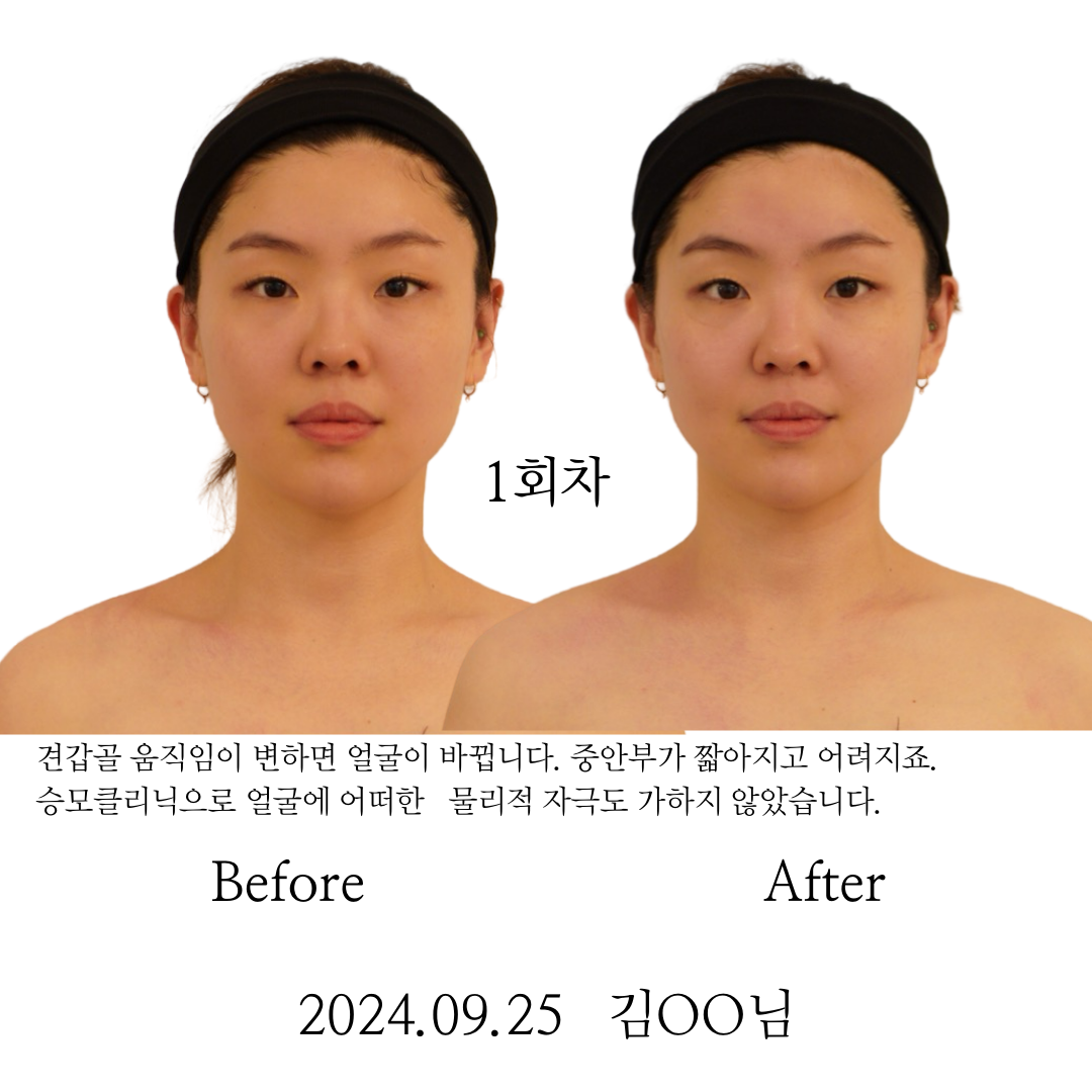 청담동 필라테스_  승모클리닉.png