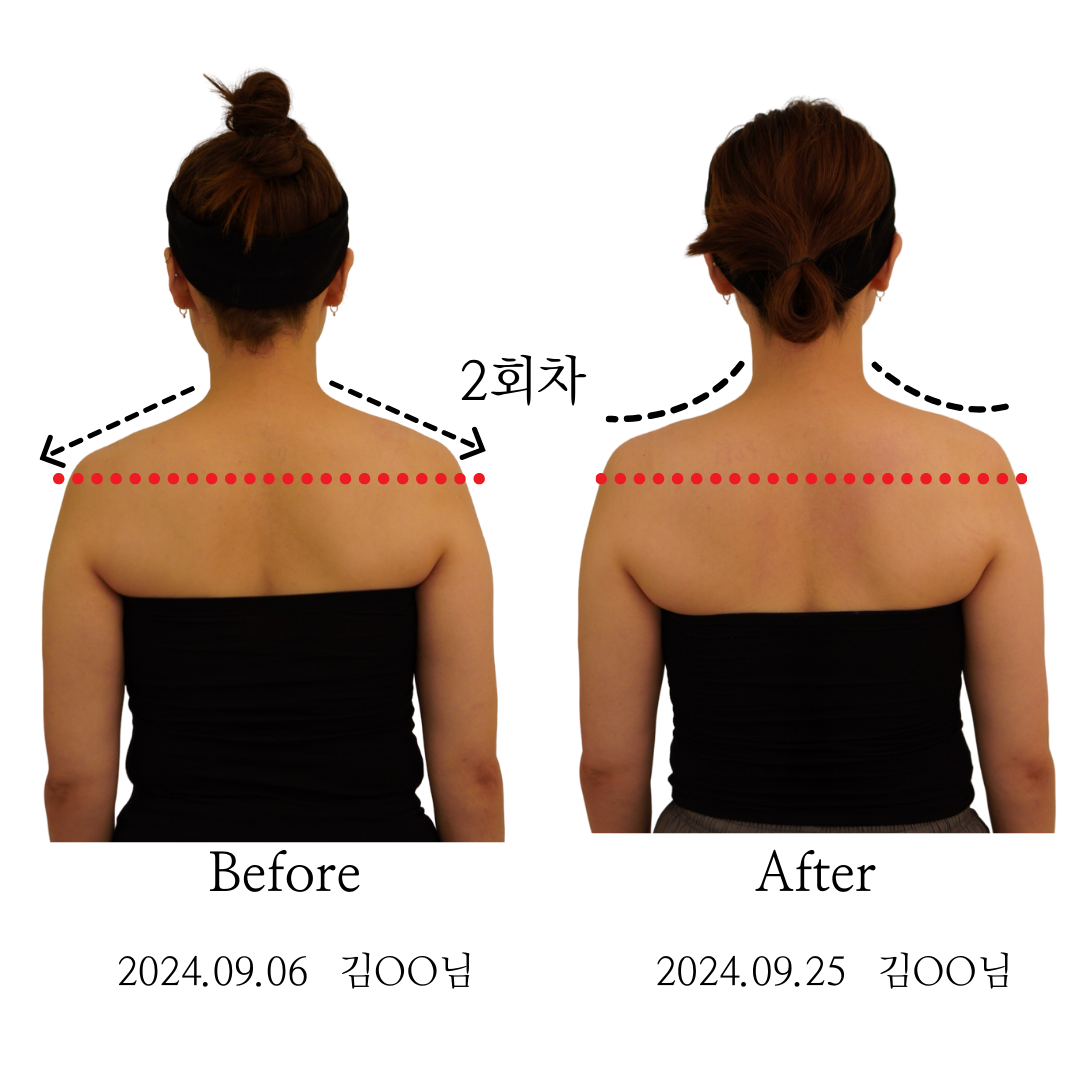 청담동필라테스_  승모클리닉.png