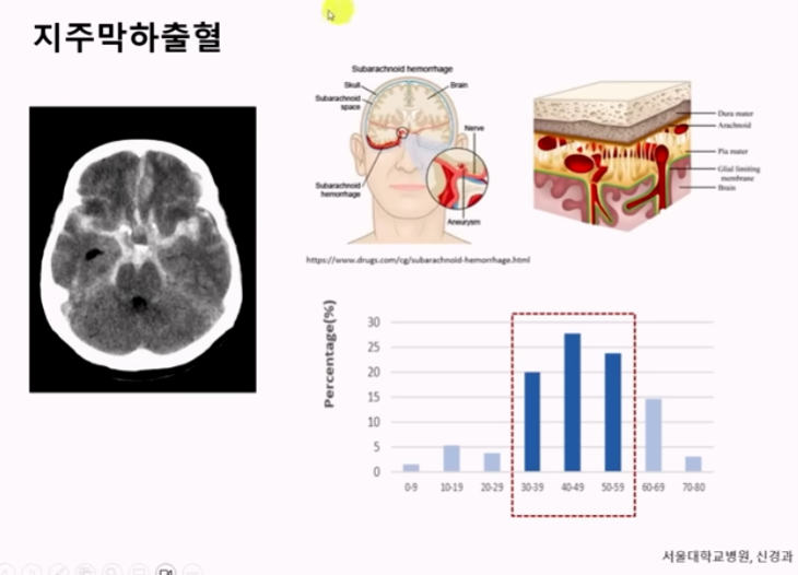 Hemorrhage Subarachnoid 2.png