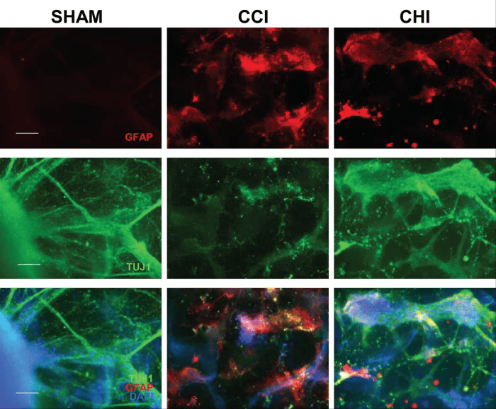 Dementia caused by Herpes HSV-1.png