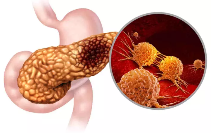 20251219 _ C형 간염 있으면 췌장암 위험 76%↑ _ 2.png