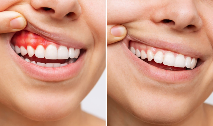 20260118 _ 잇몸 건강, 토마토를 더 먹어야 하는 이유 3가지 _ 2.png