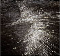 지루성 피부염.png