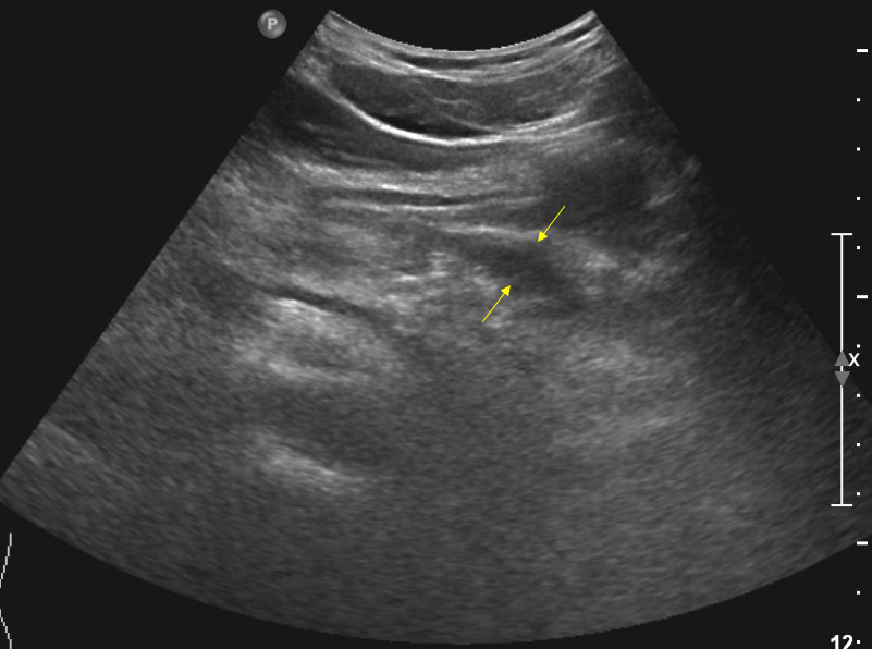 Pancreas pseudocyst.png