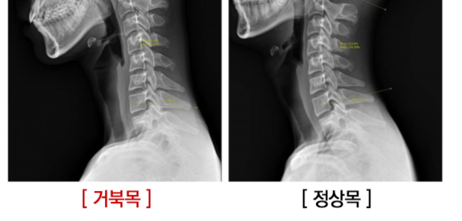 거북목 xray.png