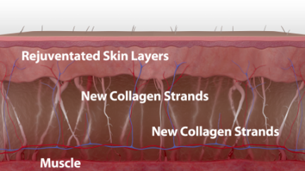 써마지 원리 5.png