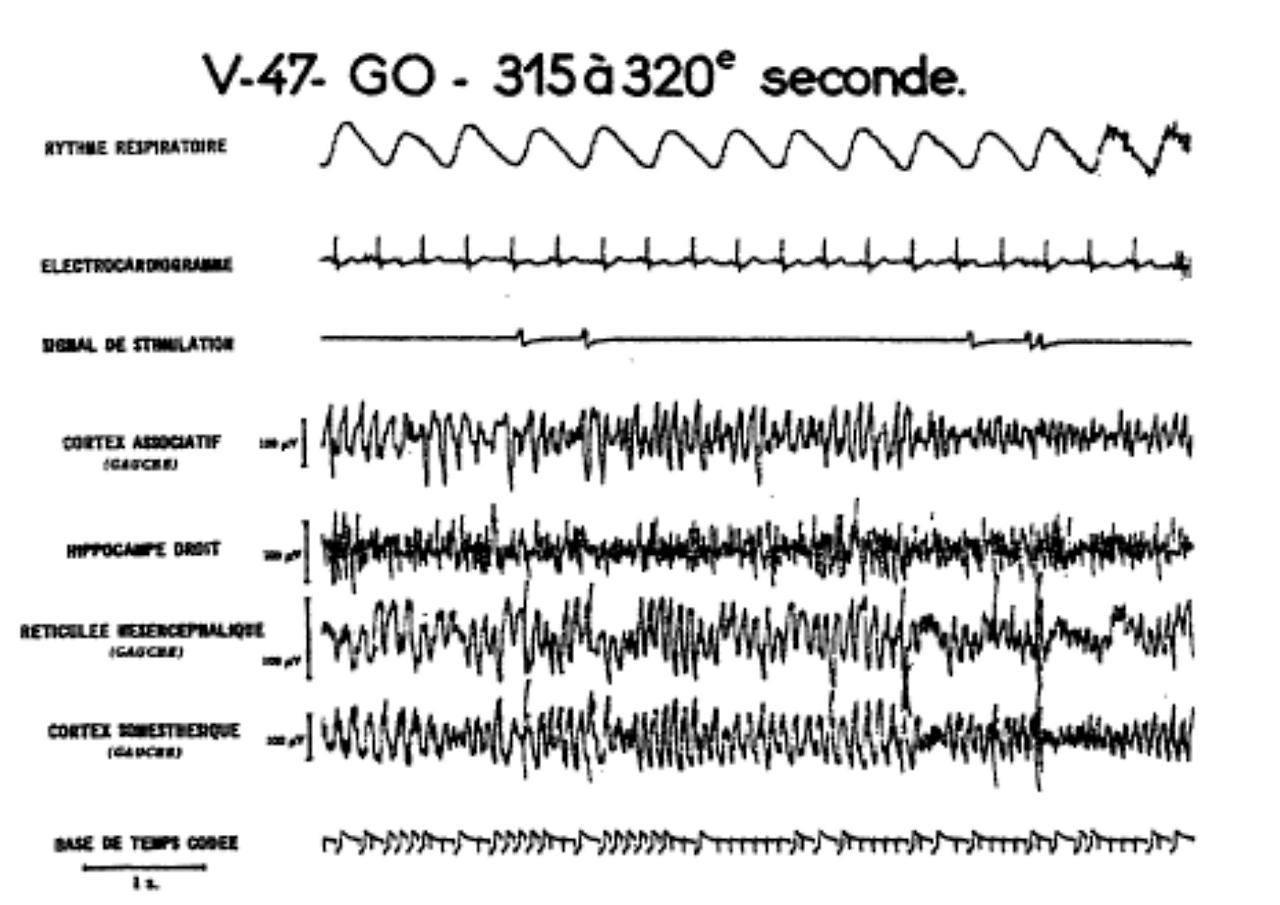펠리세트 뇌파 사진.png