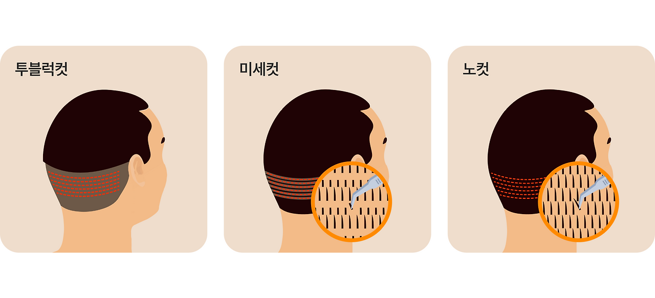 모발이식_1.png