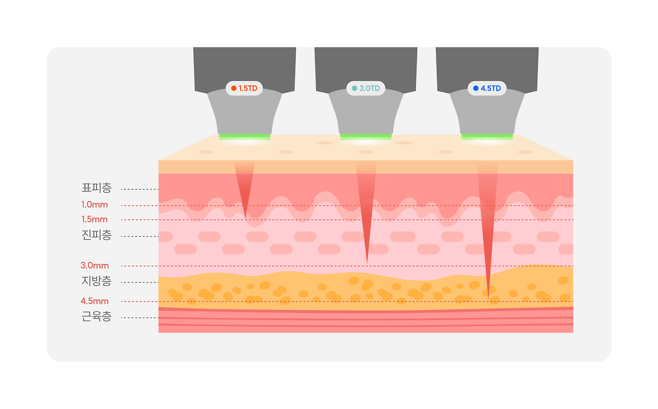 V라인 리프팅_2.png