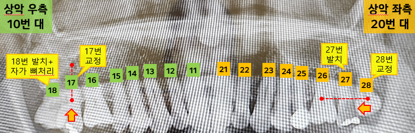 상악 좌우 교정.png