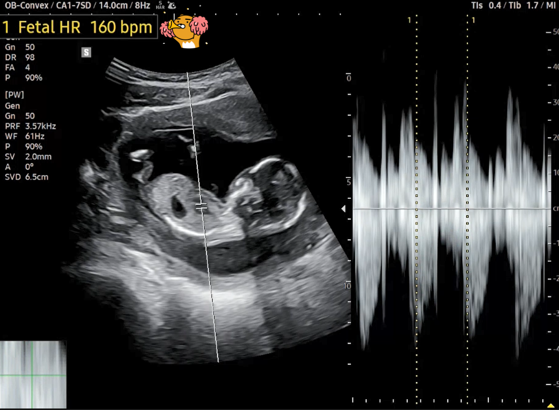 14주차 태아 심박동수.png