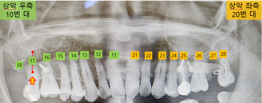 교정 부착 부위.png