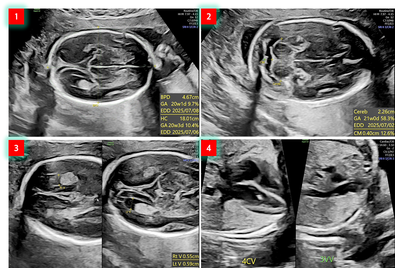 태아 측정값1.png