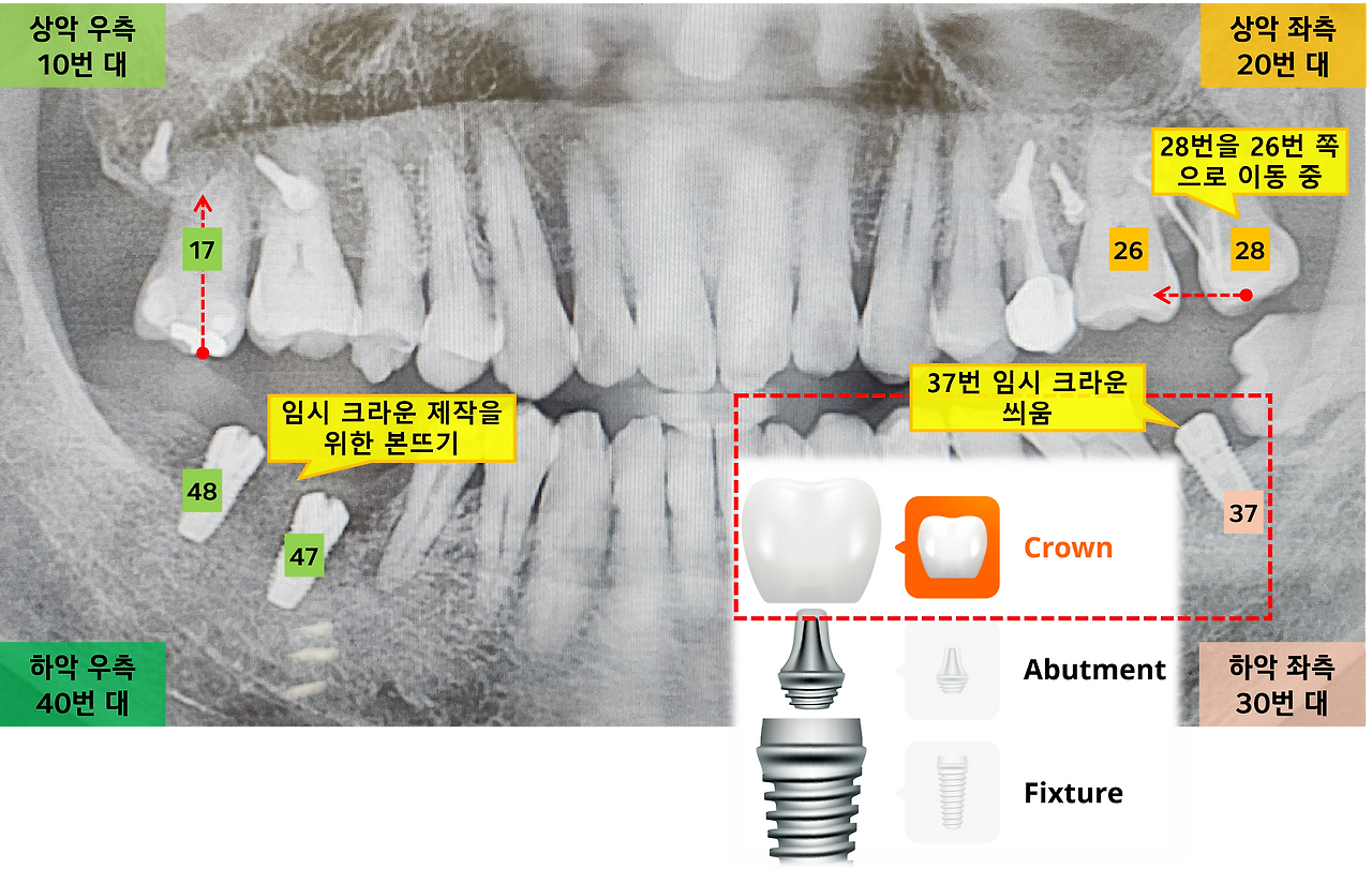 임시 크라운 부착 및 본뜨기.png