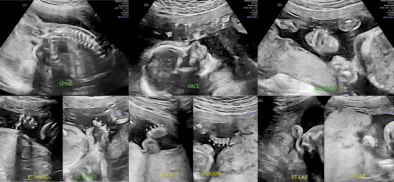 태아 몸 검사.png