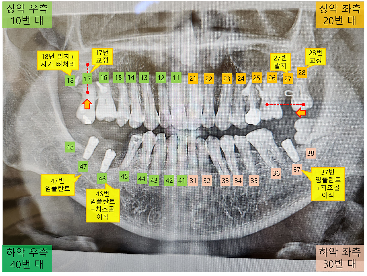 임플란트 2개 파노라마사진.png