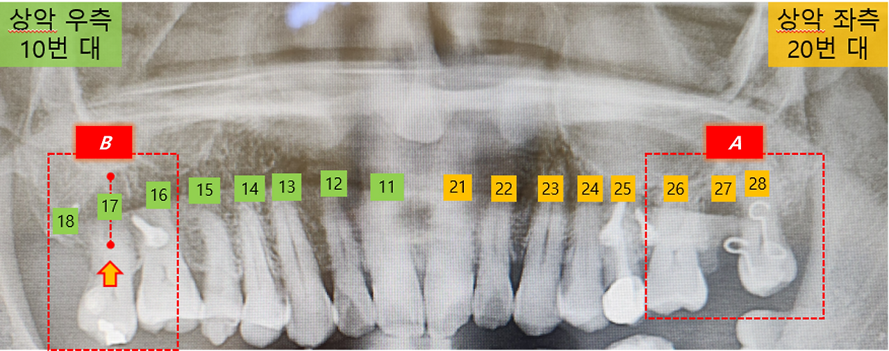 교정 장치 수정.png