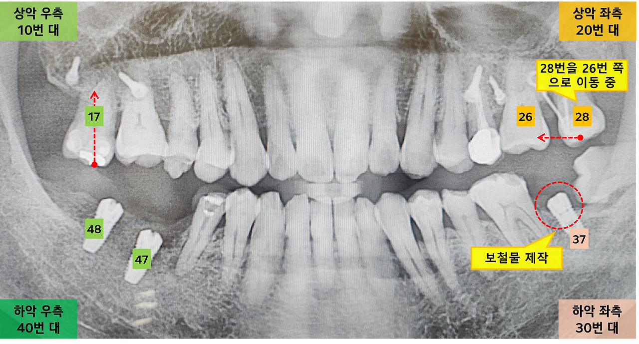 임플란트 시작 사진.png