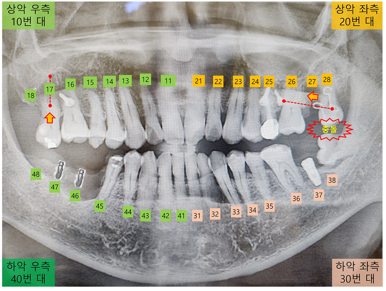 왼쪽 치아 충돌.png