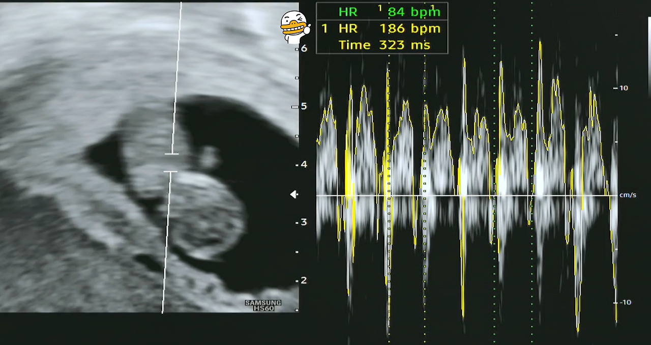 9주차 태아 심장 bpm.png