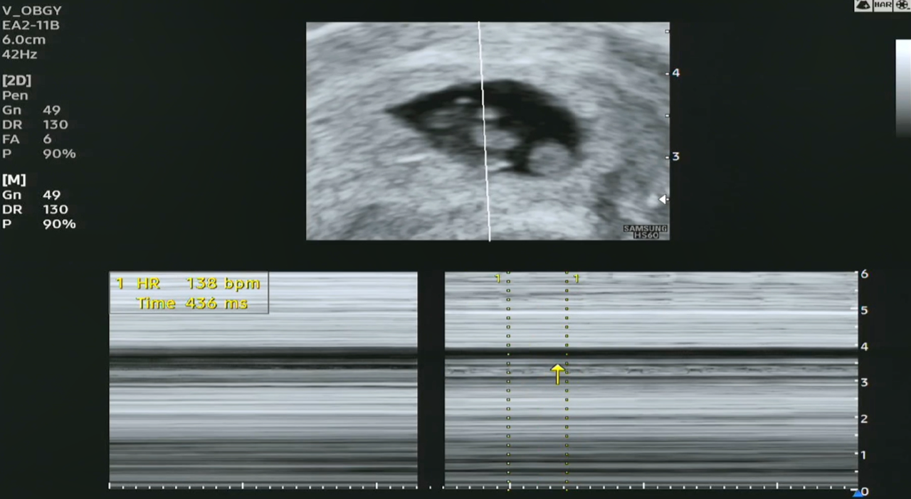 태아 심장 박동수 캡쳐.png