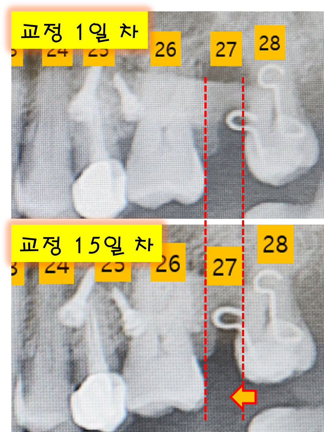 교정 15일차 변화.png