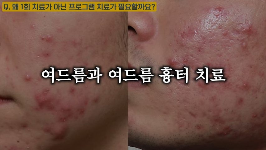 난치성 여드름 치료가 저렴할 수 없는 이유, 여드름 치료 비용 대공개 #난치성여드름 #화농성여드름 #여드름전문한의원 0-36 screenshot.png