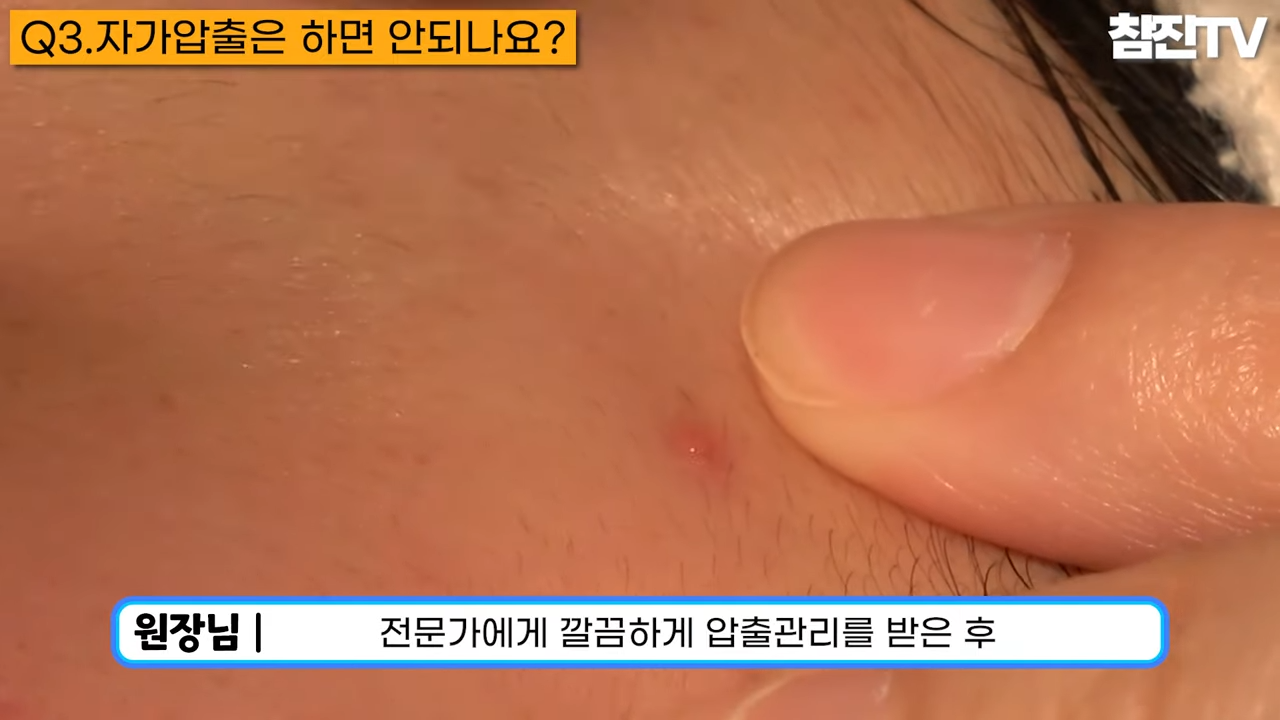 오돌토돌한 좁쌀 여드름이 나는 원인과 예방법 알려드리겠습니다! #좁쌀여드름 #여드름압출 #여드름흉터한의원 2-40 screenshot.png