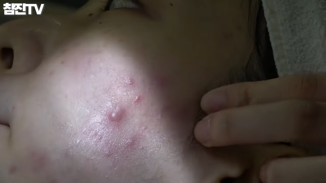 맨손으로 여드름 압출� 이 영상을 꼭 봐주세요 논란 종결!!!� 2-42 screenshot.png